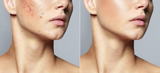 Unveiling the Power of Collagen: Can it Really Help with Acne Scars?